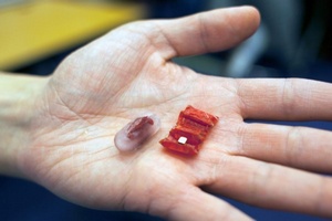 Ученые создали трансформер из мяса, помогаающий вытащить из тела человека проглоченные вещи